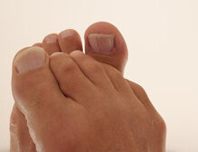 5 Natural Athlete’s Foot Remedies For Effective Relief And Healing
