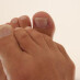 5 Natural Athlete’s Foot Remedies For Effective Relief And Healing
